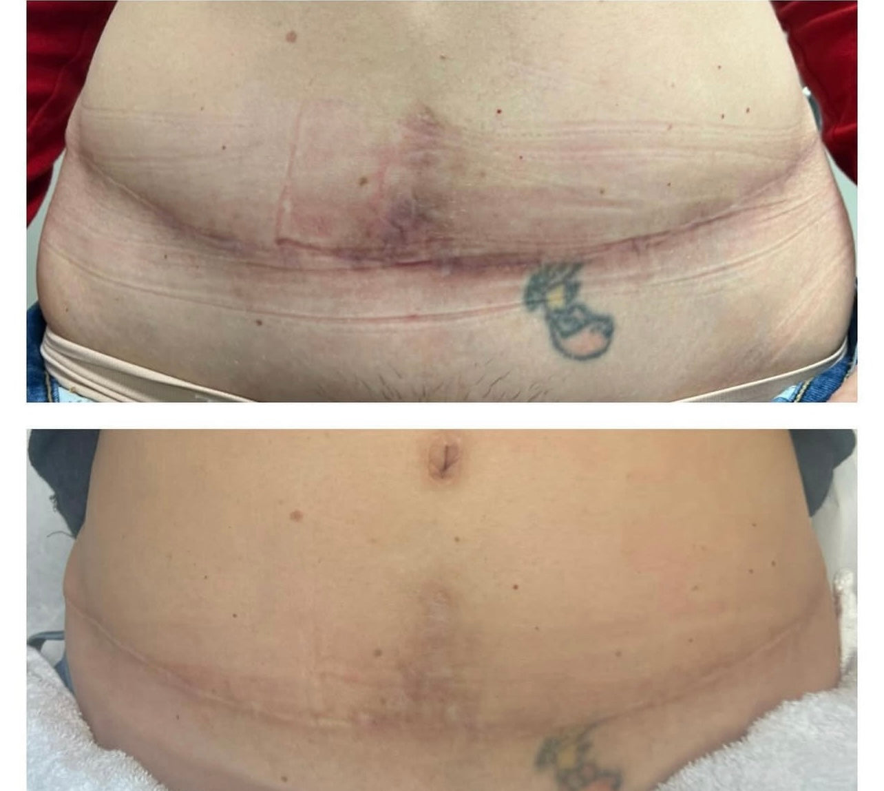 DermaRenew Scar Peel