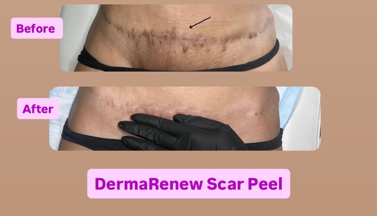 DermaRenew Scar Peel