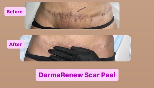 DermaRenew Scar Peel